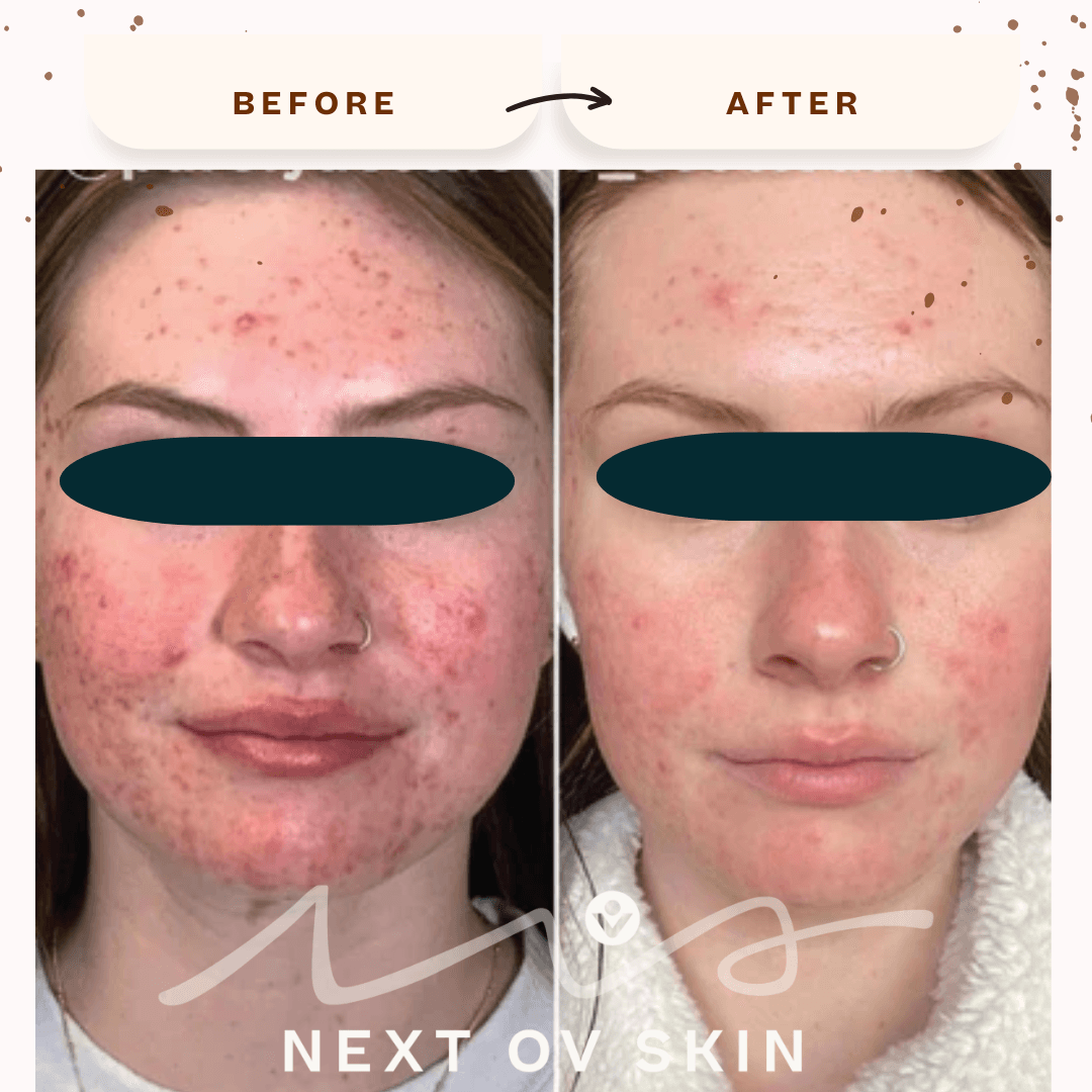 Acne scarring treatment before and after results at Next OV Skin
