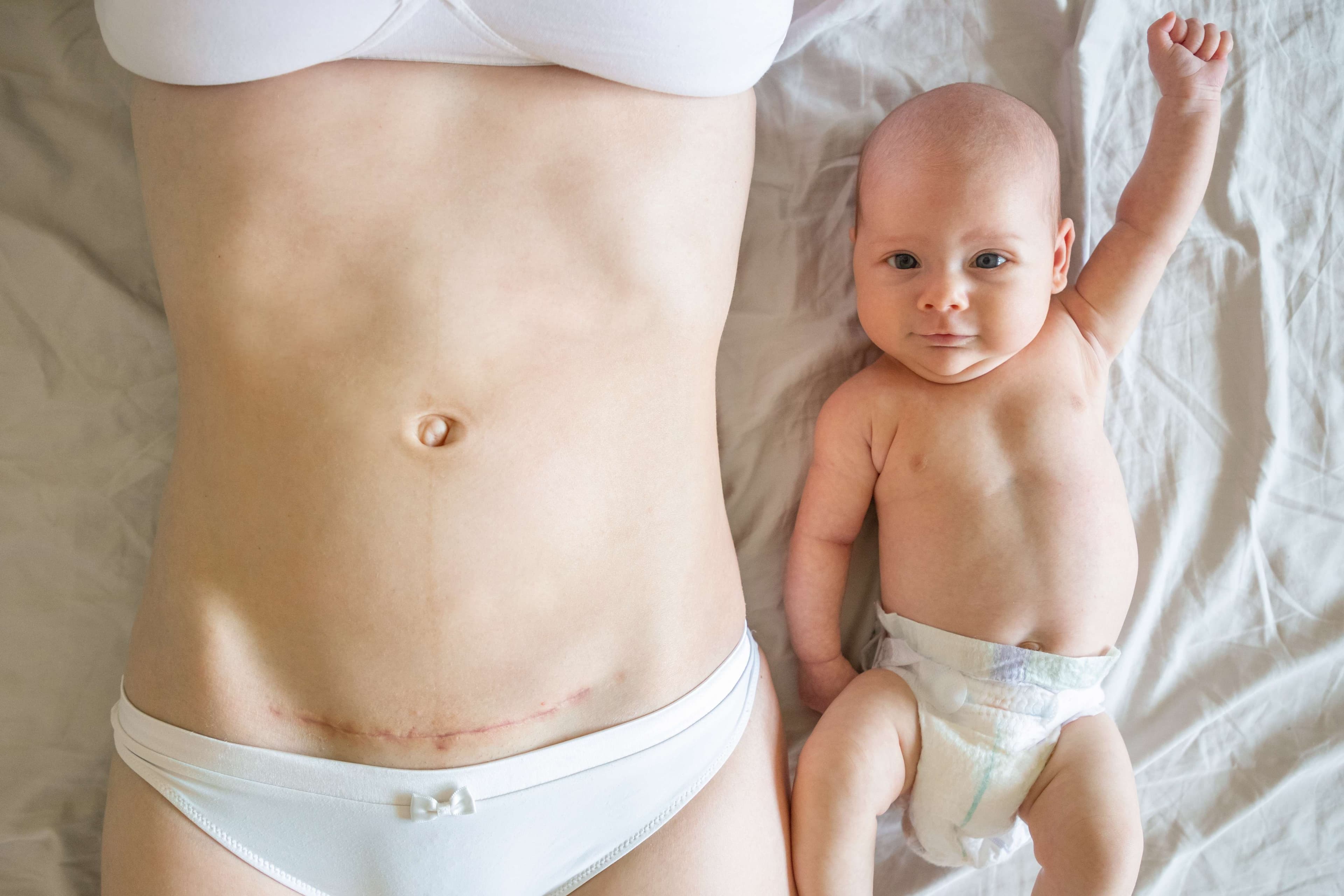 Close-up of c-section scar with baby on bed