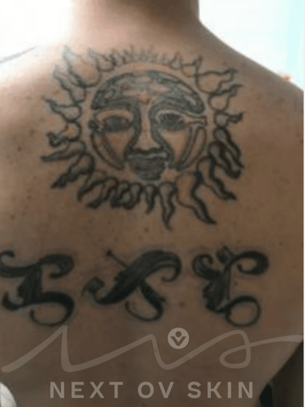 Black ink tattoo removal results on forearm