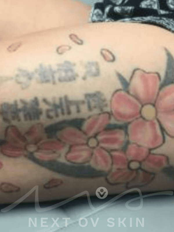 Tattoo removal progress showing significant fading after multiple sessions