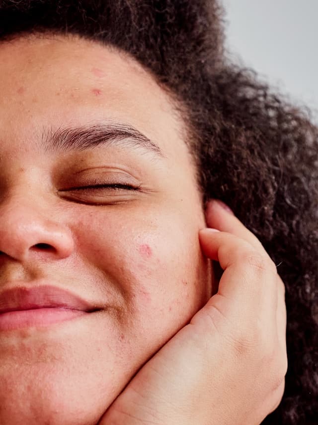 Teen receiving gentle facial peel treatment