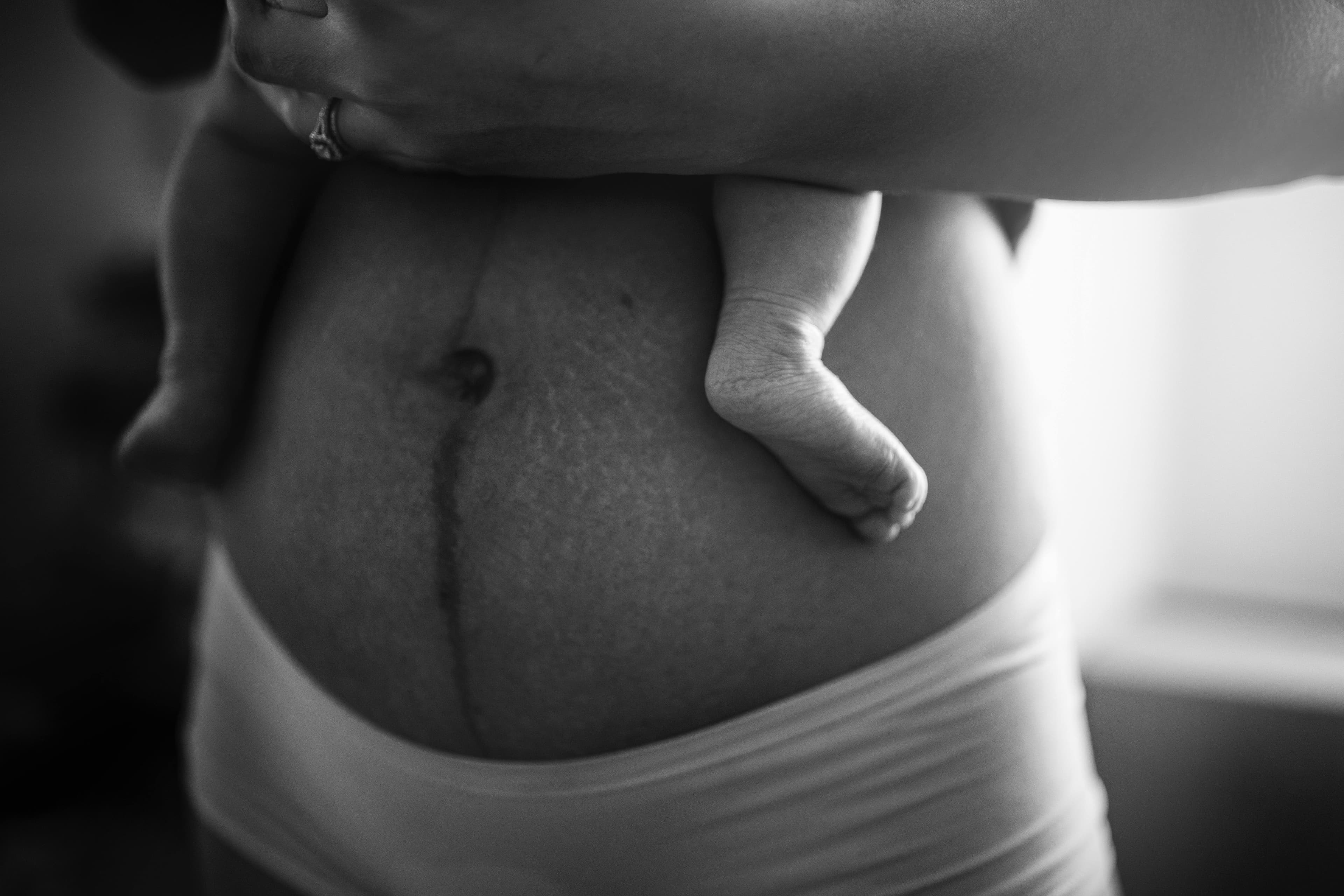 Understanding C-Section Scar Itching and What You Can Do