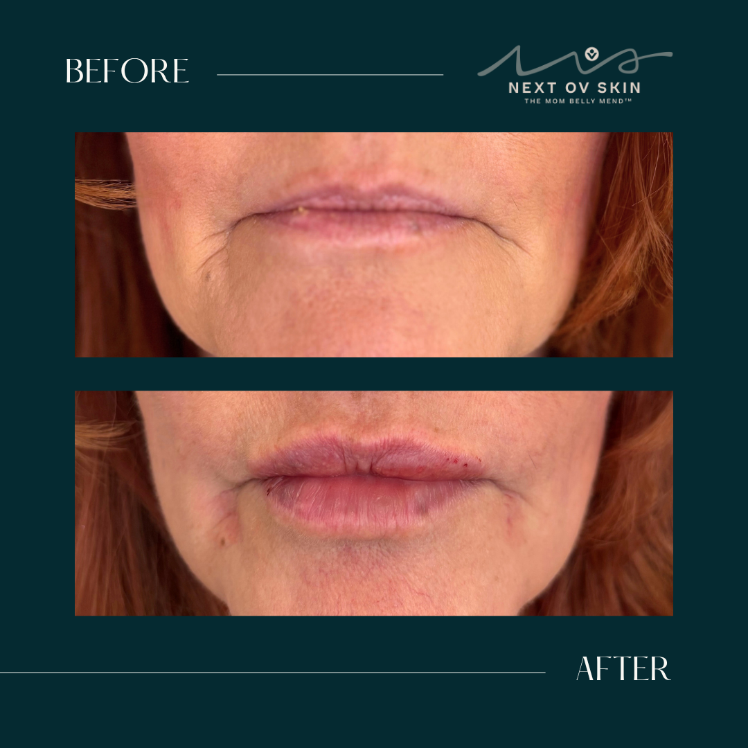 Mini Lip Plump before and after showing naturally fuller, balanced lips with a soft, defined shape.