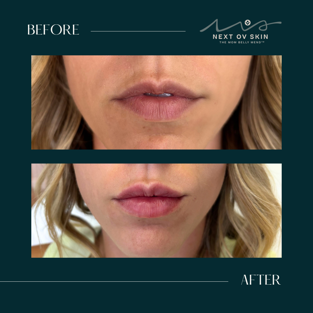 Mini Lip Plump before and after showing subtle volume and definition with a natural-looking result.