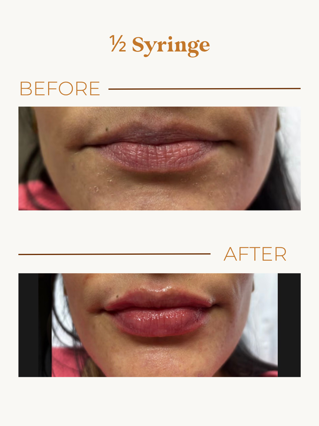 Mini Lip Plump before and after showing a soft half-syringe enhancement with natural definition.