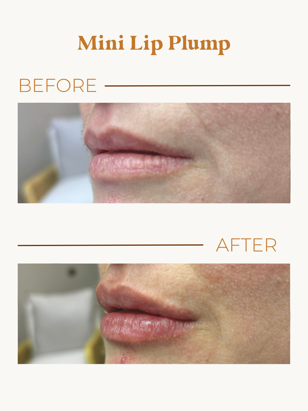 Mini Lip Plump before and after profile view showing soft, natural-looking fullness.